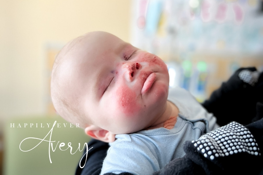 BMT DAY +13 her poor little face